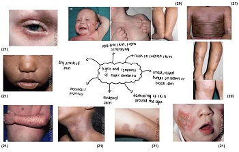The common signs and symptoms of atopic dermatitis